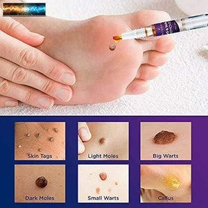 NOVOME Skin Tag Remover & Wart Remover - Quickly and Easily Remove Common Skin T