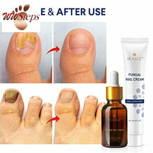 Load image into Gallery viewer, BEALUZ Fungal Nail Treatment Liquid and Cream Kit, Repair Fungal Infected Nails,

